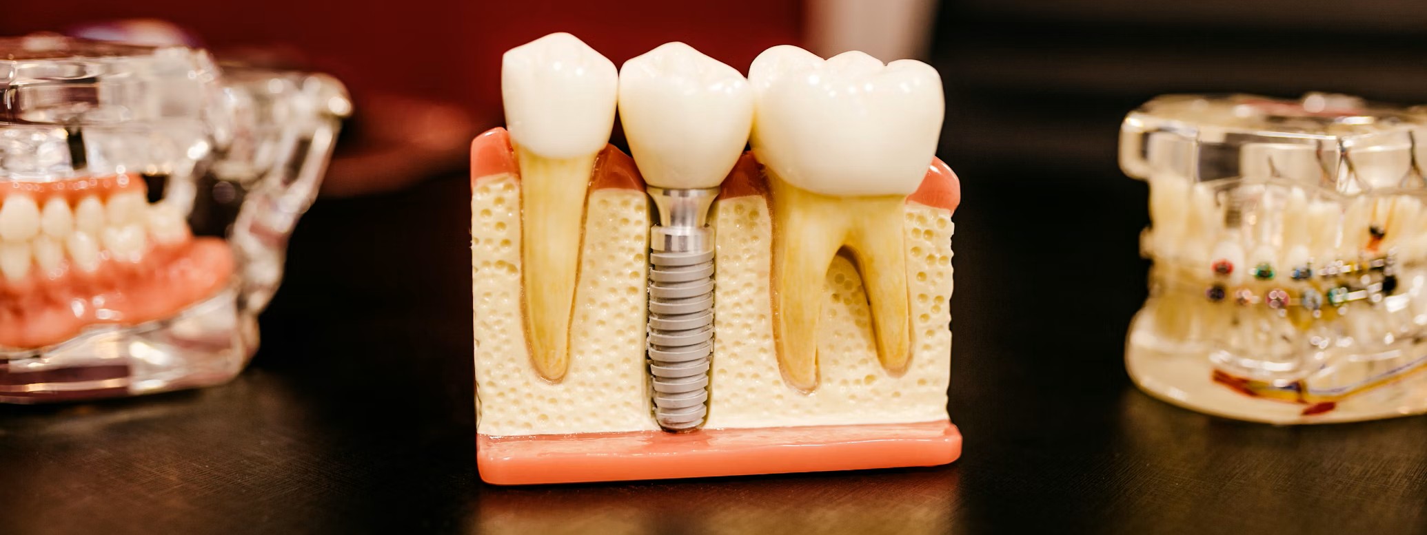 Implant dentar NewOrtoSmile